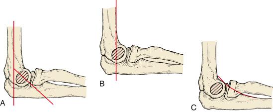 Fig. 17.7, Radiographic lines that may be demonstrated on a lateral radiograph of the elbow. (A) The lateral capitellar angle is measured by the intersection of a line parallel to the midpoint of the distal humeral shaft and one drawn through the midpoint of the capitellum. The normal inclination is approximately 30 degrees anterior. (B) The anterior humeral line is drawn along the anterior cortex of the distal end of the humerus. Distally, it should intersect the middle of the ossified capitellum. (C) The anterior coronoid line is drawn along the volar margin of the proximal ulna. As it is continued proximally, the line should just touch the anterior margin of the capitellum.