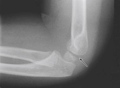 Fig. 17.8, Lateral radiograph of a normal elbow. The physis of the capitellum is normally slightly wider posteriorly than anteriorly (arrow) . This finding should not be confused with an injury to the physis.
