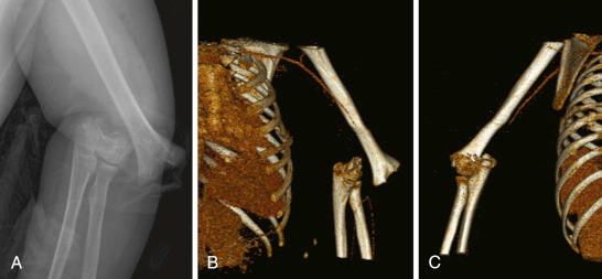 Fig. 17.10, Vascular injury associated with supracondylar humeral fracture. (A) Severely displaced supracondylar humeral fracture. (B and C) Anteroposterior and lateral three-dimensional computed tomographic angiograms demonstrating occlusion of the brachial artery. Note the distal runoff despite the vascular occlusion, emphasizing the robust collateral circulation about the elbow.