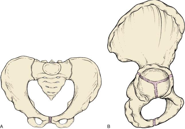 Fig. 11.1, Pediatric pelvic osseous anatomy. (A) The inlet orientation illustrates the two innominate bones, the sacrum, and the pubic symphysis. (B) The lateral orientation reveals the triradiate cartilage as the confluence of the iliac, ischial, and pubic apophyses.