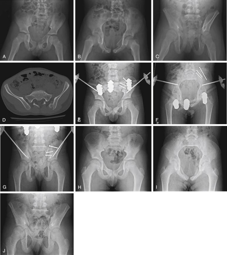 Fig. 11.11, An 8-year-old boy run over by a pickup truck sustaining a highly displaced Tile C2 injury. (A-C) Anteroposterior, inlet, and outlet radiographs demonstrate disrupted bilateral anterior rami and posterior arch. (D) Computed tomographic scan confirms left-sided crescent fracture dislocation and right-sided anterior sacroiliac joint diastasis. (E-G) Open reduction of left posterior crescent fracture dislocation with supplemental anterior pelvic external fixation on anteroposterior, inlet, and outlet views. (H-J) At 2 years, there were no concerns of complications, and the bilateral sacroiliac joint and acetabular apophyses remained open. Hardware was removed 1 year after the index procedure.