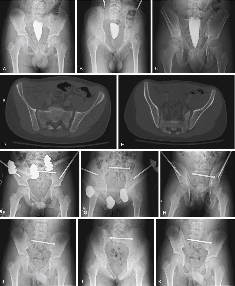 Fig. 11.12, A 12-year-old boy run over by a bus sustaining a moderately displaced Tile B3 injury. (A-C) Anteroposterior, inlet, and outlet radiographs demonstrate a right-sided zone 3 sacral fracture and left-sided anterior sacroiliac diastasis with bilateral anterior rami fractures. (D-E) Computed tomographic scans confirm bilateral posterior arch disruption with left open-book external rotation and right lateral compression sacral fractures. (F-H) Left-sided percutaneous sacroiliac screw placement with supplemental anterior external fixation. (I-K) External fixation was removed at 6 weeks, and the patient regained full function when followed up at 6 months after injury with healed fractures.