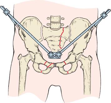 Fig. 11.13, A simple two-pin external fixator for resuscitation of a child with hemodynamic instability from pelvic hemorrhaging. The 4- or 5-mm Schanz pins are inserted through small stab wounds. Two single adjustable clamps and a tube-to-tube clamp connect two 250-mm carbon fiber rods. With the assistant compressing the pelvis externally to close the volume down, the surgeon tightens the clamps.