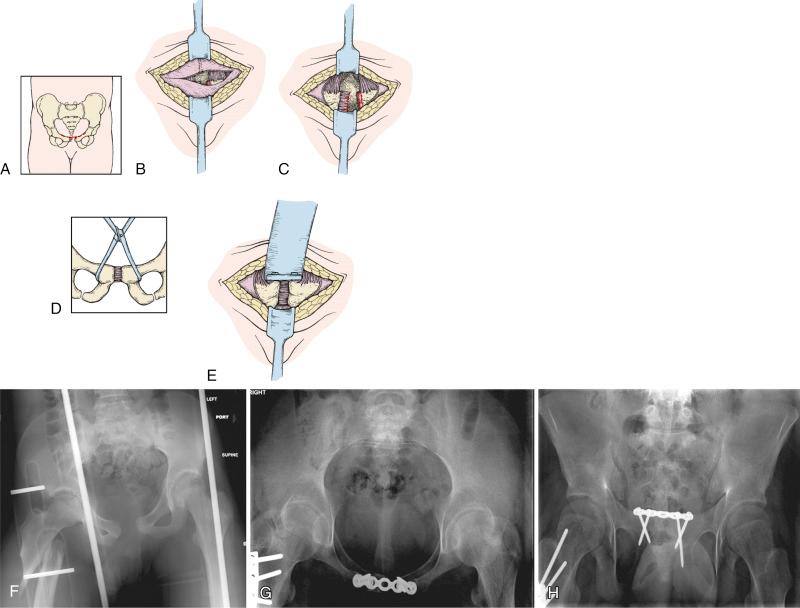 Fig. 11.14, A simple two-hole plate may be used for closing an open-book deformity. (A) If the child has (or is having) a laparotomy through a midline incision, this plate is easily applied by exposing the superior aspect of the pubis bilaterally. If not, the Pfannenstiel approach is preferred. (B) With this approach, one side of the rectus abdominis is generally seen to be avulsed from the pubis. (C) With a periosteal elevator, the opposite pubis is exposed. (D) A reduction forceps is then applied to the anterior aspect of the pubis bilaterally to close the deformity. A Schanz pin 4 or 5 mm in diameter can be inserted through a percutaneous incision into the iliac crest to help with this reduction. (E) Generally, 3.5-mm cortical screws with a four- or five-hole 3.5-mm reconstruction plate are recommended for children younger than 12 years. (F) A 12-year-old victim of blunt trauma with an open-book injury and subtrochanteric femur fracture. (G and H) Open reduction with internal fixation of the pelvic ring as described above as rod and plate fixation of the subtrochanteric femur fracture.