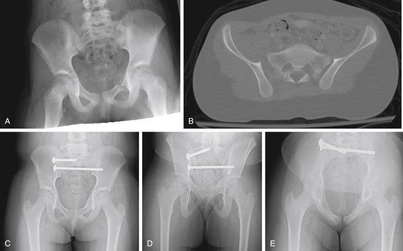 Fig. 11.15, A 9-year-old female was injured in a motor vehicle accident. (A) Anteroposterior (AP) pelvis radiograph demonstrating bilateral SI disruption and multiple pubic rami fractures. (B) Axial computed tomography image demonstrating significant displacement of the right SI joint. Postoperative AP (C), outlet (D), and inlet (E) radiographs reveal dysmorphic sacrum and enlarged S2 corridor, therefore requiring the shorter screw construct.