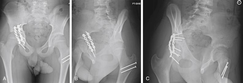 Fig. 11.16, (A-C) The same patient as in Fig. 11.15 , post–open reduction and internal fixation, transverse acetabulum fracture via plating pattern used for isolated posterior column fracture. The patient underwent staged left hip surgical dislocation and reduction and repair of posterior labral osteochondral avulsion.