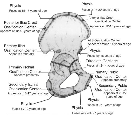 Fig. 11.2, The location of ossification centers in the pelvic bone, noting when they appear and when physes fuse. Note the Y-shaped triradiate cartilage at the acetabulum.