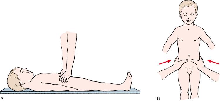 Fig. 11.4, Clinical examination of pelvic stability. (A) Examining for anteroposterior instability by applying posteriorly directed force on the anterior iliac crests. The examination is most effective when done early, while the patient is in the emergency department and still on the backboard used for transport. (B) Examination for external rotation stability (such as that occurring in an open-book fracture, type B1) by applying force on the external aspect of the pelvis and directing it toward the midline.