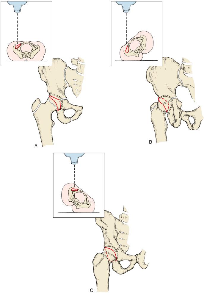 Fig. 11.5, Schematics of three radiographic views necessary for assessment of acetabular fractures. (A) The anteroposterior pelvis (or hip) view allows assessment of the iliopectineal line, the ilium, the anterior and posterior walls, and the pubis. (B) The iliac oblique view of Judet allows optimal assessment of the ischial spine, the posterior column and anterior wall, and the iliac fossae. (C) The obturator oblique view of Judet allows optimal assessment of the iliac wing, anterior column and posterior wall, and the obturator foramen.