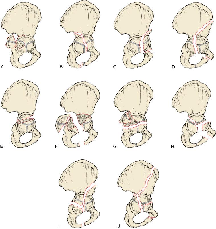 Fig. 11.6, The acetabular fracture classification of Letournel and Judet. (A) Posterior wall fracture; this fracture is often associated with impaction of the intact side of the fracture margin. (B) Posterior column fracture. (C) Anterior wall fracture; an atypically large fragment size is shown. (D) Anterior column fracture; the most posterior location of the fracture line through the acetabulum is shown. (E) Transverse fracture pattern; this location is transtectal. The fracture may cross the acetabulum either higher (juxtatectal) or lower (infratectal). (F) Associated posterior column and posterior wall fractures. (G) Associated transverse and posterior wall fractures. (H) T-shaped fracture. (I) Associated anterior column and posterior hemitransverse fractures. (J) A both-column fracture; note that no segment of the acetabulum remains attached to the intact ilium.