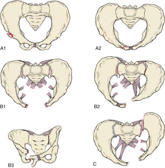 Fig. 11.7, The Pennal-Tile classification of pelvic fractures as applied to children. Type A1: An avulsion fracture of the anterior inferior iliac spine (the straight head of the rectus femoris muscle). Type A2: A minimally displaced fracture of the ischium and pubis without posterior ring injury. Type B1: An anteroposterior force has produced an open-book injury with more than 3 cm of symphyseal disruption. By definition, the anterior portion of the sacroiliac joints has been disrupted. Type B2: A lateral compression mechanism has produced an ipsilateral anterior sacral alar crush and displaced ischial and pubic ramus fractures. Type B3: The same force vector (laterally applied, oriented toward the midline in the coronal plane) has produced contralateral disruption of the sacroiliac joint (with a minor ipsilateral anterior sacral impaction) and displaced pubic and ischial ramus fractures. Type C: A Pennal-Tile IIIC1 injury with total disruption of the sacroiliac joint and posterior vertical and rotational displacement of the hemipelvis associated with symphyseal disruption.