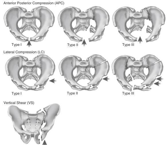 Fig. 11.8, The classification of pelvic disruptions as described by Young et al.