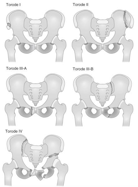 Fig. 11.9, The modified Torode classification. Torode I (avulsion fractures): avulsion of the bony elements of the pelvis, invariably a separation through or adjacent to the cartilaginous growth plate. Torode II (iliac wing fractures): resulting from a direct lateral force against the pelvis, causing a disruption of the iliac apophysis or an infolding fracture of the wing of the ilium. Torode III-A (simple anterior ring fractures): this group involved only children with stable anterior fractures involving the pubic rami or pubic symphysis. Torode III-B (stable anterior and posterior ring fractures): this new group involved children with both anterior and posterior ring fractures that were stable. Torode IV (unstable ring disruption fractures): this group of children had unstable pelvic fractures, including ring disruptions, hip dislocations, and combined pelvic and acetabular fractures.