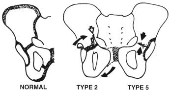 Fig. 11.10, Schematic drawing of type II and type V growth-mechanism injuries. A type II injury is often associated with a rotatory disruption of the ischiopubic unit (curved arrows). A Thurston-Holland fragment (open arrow) occurs along the medial wall of the pelvis. Type V is a crushing injury (arrows) .