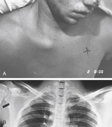 Fig. 16.1, Fracture of the medial portion of the clavicle. (A) This patient sustained multiple injuries; the prominence of the right medial clavicle is obvious. (B) A chest radiograph shows the asymmetry consistent with a medial physeal injury (the epiphysis is unossified). Incidental note is made of a contralateral first-rib fracture.