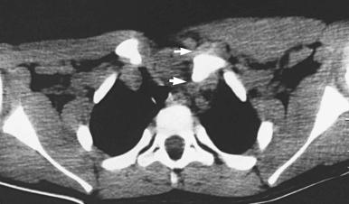 Fig. 16.3, Computed tomographic scan of an adolescent with a left posterior sternoclavicular dislocation (arrows) . Note the impingement on the posterior structures.