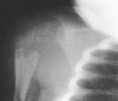 Fig. 16.4, Pseudoparalysis of the shoulder. This 4-week-old infant with pseudoparalysis after injury was treated for a clavicular fracture. The child was seen again in follow-up at 2.5 weeks, at which time the abnormal appearance of the proximal humeral metaphysis was apparent. Aspiration confirmed osteomyelitis. The differential diagnosis of pseudoparalysis in such a case is clavicular, proximal humeral, or scapular trauma; brachial plexus palsy; or sepsis of the joint, neighboring bone, or both.
