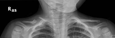 Fig. 16.5, 2 years, 6 months-old boy with congenital pseudarthrosis of the right clavicle. The child was asymptomatic and treated with observation.