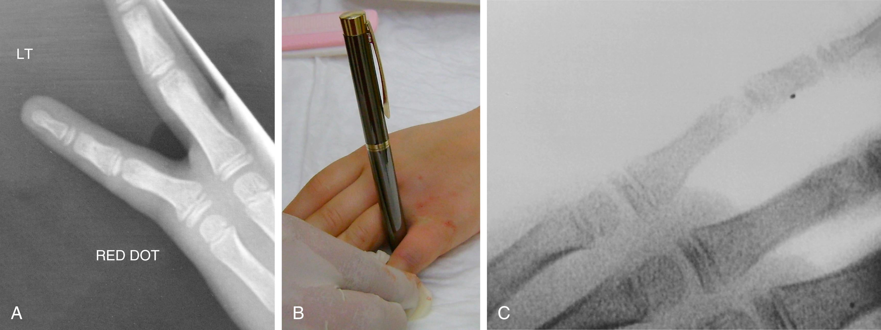 Fig. 56.1, Example of Salter–Harris II. (A) Pre-reduction radiograph; (B) mode of reduction; (C) post-reduction radiograph.