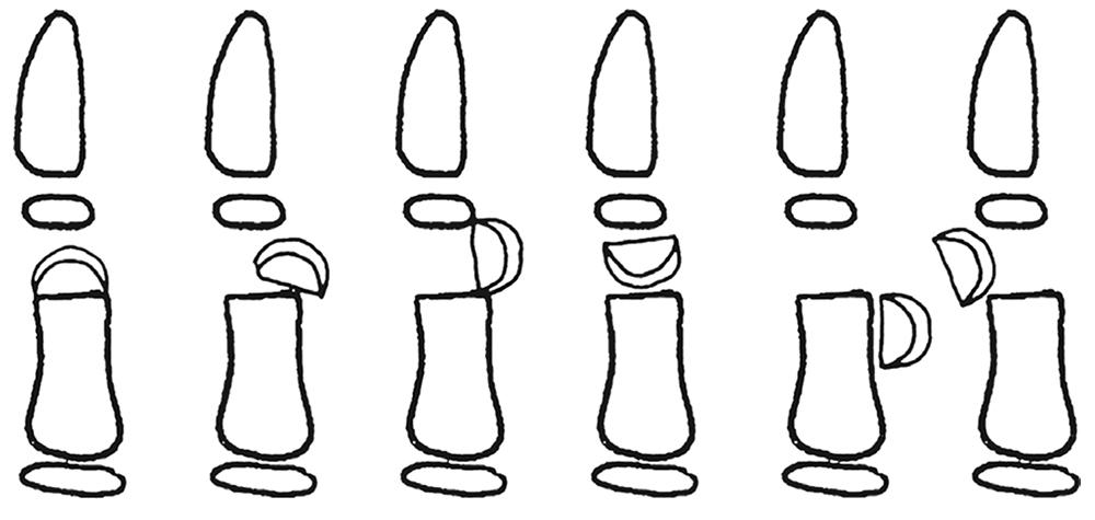 Fig. 56.3, Classification of fractures of neck of proximal phalanx in children.