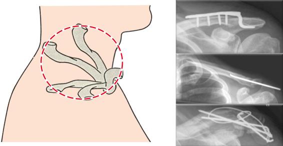 Fig. 48.1, The reason for the high rate of failure of the lateral clavicular osteosynthesis is the range of motion in that joint.