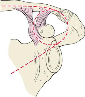 Fig. 48.2, Goss introduced the concept of the shoulder suspensory complex. The link between the trunk and the upper limb is conceptualized as two struts (the clavicle and the lateral border of the scapula connected to a bone-ligament ring). Injury to one component of the complex usually does well with nonoperative treatment. Operative treatment is more often considered for double disruptions of the complex.