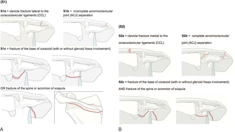 Fig. 48.3, (A and B) Classification system of lateral scapular suspension system (LSSS) failure. 91 LSSS is classified according to three failure conditions: S0, S1, and S2. Within each of the S1 and S2 categories, failures are further subdivided into three groups. S1 incomplete LSSS failures include clavicle fracture lateral to the S0 in which the LSSS is intact and no failure is diagnosed; S1 in which there is incomplete failure of the LSSS (see Fig. 48.1 ); S2 in which there is (a) complete failure of the LSSS, coracoclavicular ligaments (CCLs), (b) complete acromioclavicular joint (ACJ) separation, and (c) fracture of the base of coracoid (with or without glenoid fossa involvement) or fracture of the spine or acromion of the scapula. S2 complete LSSS failures include (a) clavicle fracture medial to the CCL, (b) complete ACJ separation, and (c) fracture of the base of coracoid and fracture of the spine or acromion of scapula.