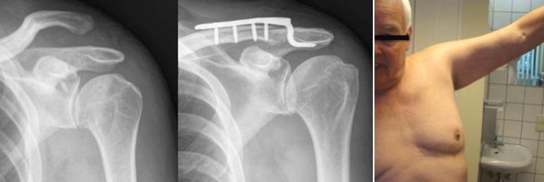 Fig. 48.4, Rockwood type V lesion treated by hook plate.