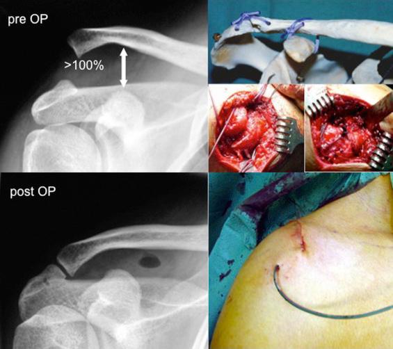 Fig. 48.5, In case of ligamentous disruption of the acromioclavicular (AC) and coracoclavicular (CC) ligaments, an open reconstruction and PDS suture augmentation can be performed by making a figure-of-eight sling around the clavicle and the coracoid and a transosseous fixation through the acromion and the clavicle.