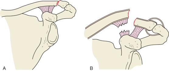 Fig. 48.7, When the distal end of the clavicle is fractured, the ligaments may either remain intact and serve to maintain apposition of the fracture fragments (A, type I) or rupture and allow wide displacement of the fragments (B, type II).