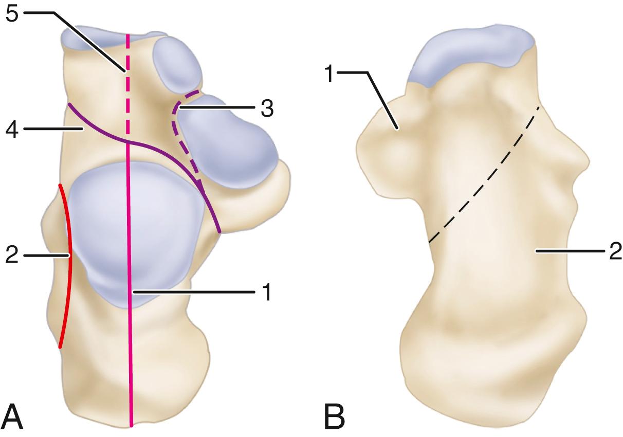 FIGURE 89.1, Dorsal and plantar views illustrating common fracture lines in intraarticular fractures of calcaneus. A, Dorsal view: 1 , sagittal fracture through posterior facet; 2 , lateral wall fracture; 3 , fracture line separating remainder of calcaneus from sustentaculum fragment; 4 , transverse fracture through sinus tarsi; 5 , fracture extending into calcaneocuboid joint. B, Plantar view: 1 , medial wall fracture in which tuberosity fragment shifts distally and laterally with medial overlap; 2 , tuberosity fragment has variable fracture line or lines.