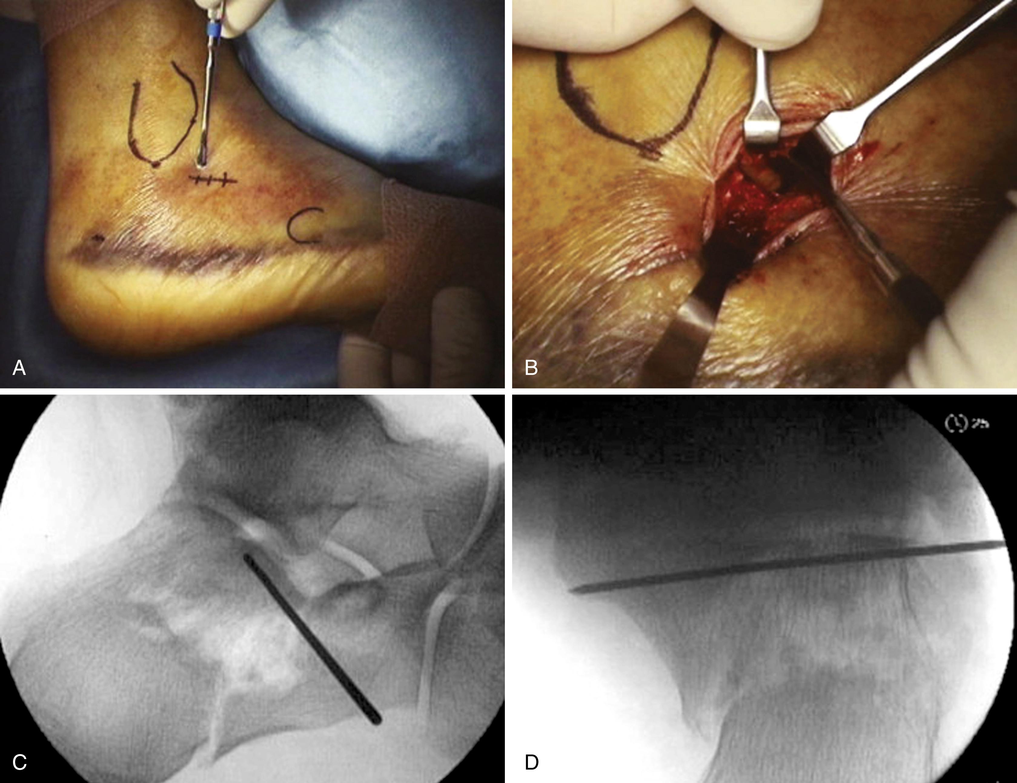 FIGURE 89.11, Percutaneous reduction and fixation of calcaneal fracture (see text). A and B, Posterior facet is reduced through small stab incision. C to F, Provisional fixation with Kirschner wires. G and H, Definitive fixation with cannulated screws. I, Skin incision after reduction and fixation. SEE TECHNIQUES 89.3 AND 89.5.