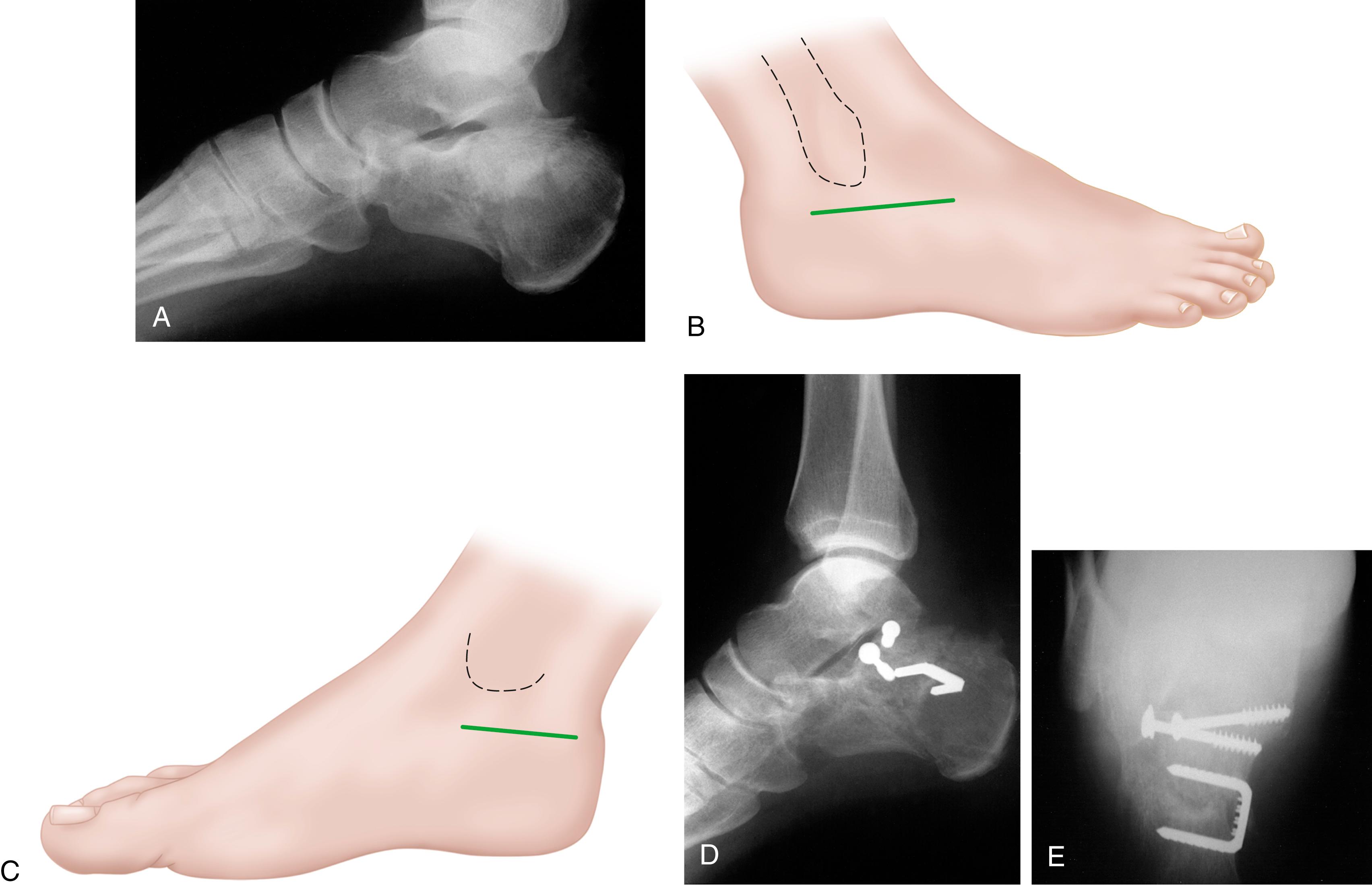 FIGURE 89.12, A, Preoperative radiograph. Medial and lateral incisions were chosen in this patient because of his significant smoking history. B, Lateral incision. C, Medial incision. D and E, Postoperative radiographs. SEE TECHNIQUE 89.3.