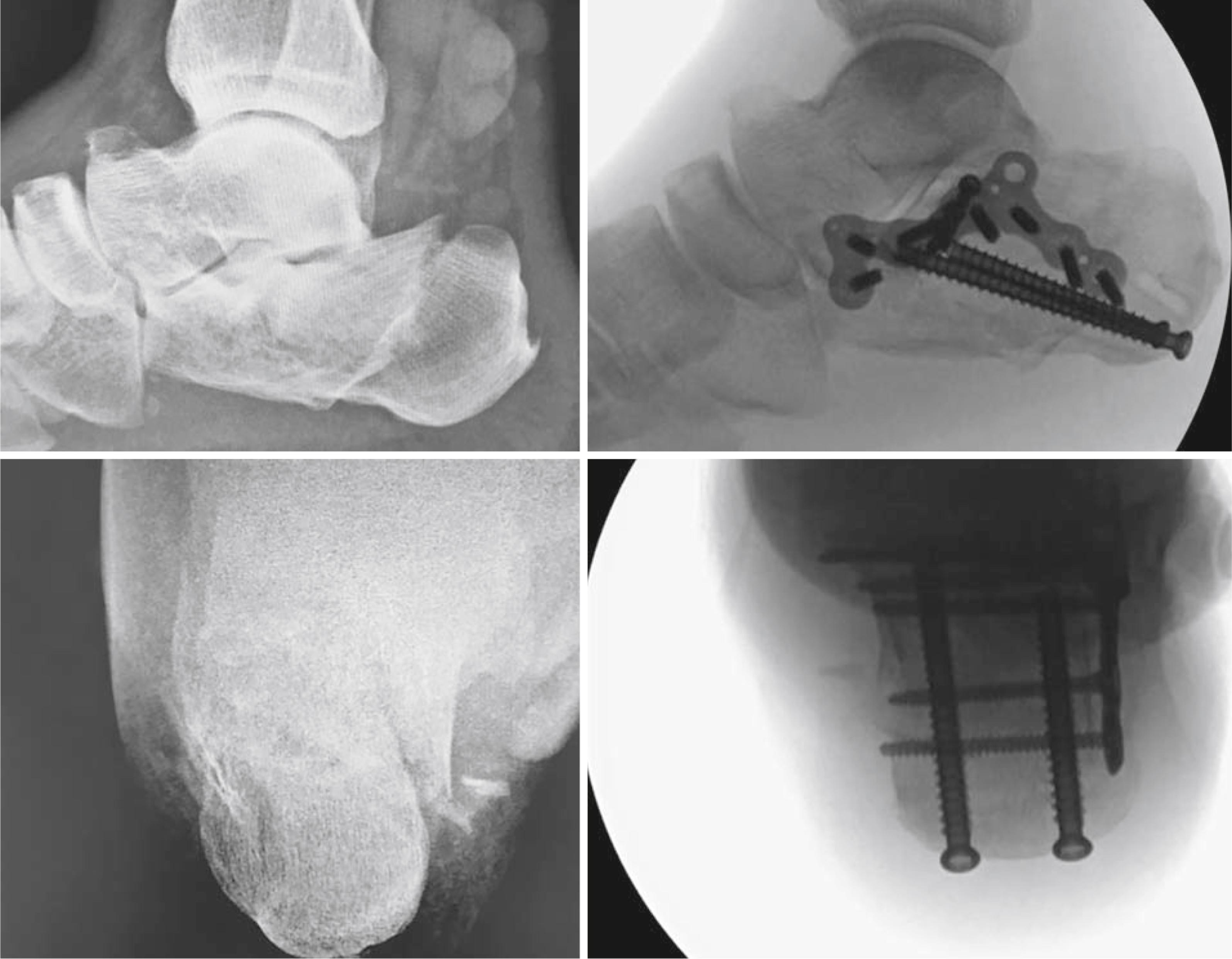 FIGURE 89.14, Lateral plate fixation of calcaneal fracture. SEE TECHNIQUE 89.3.