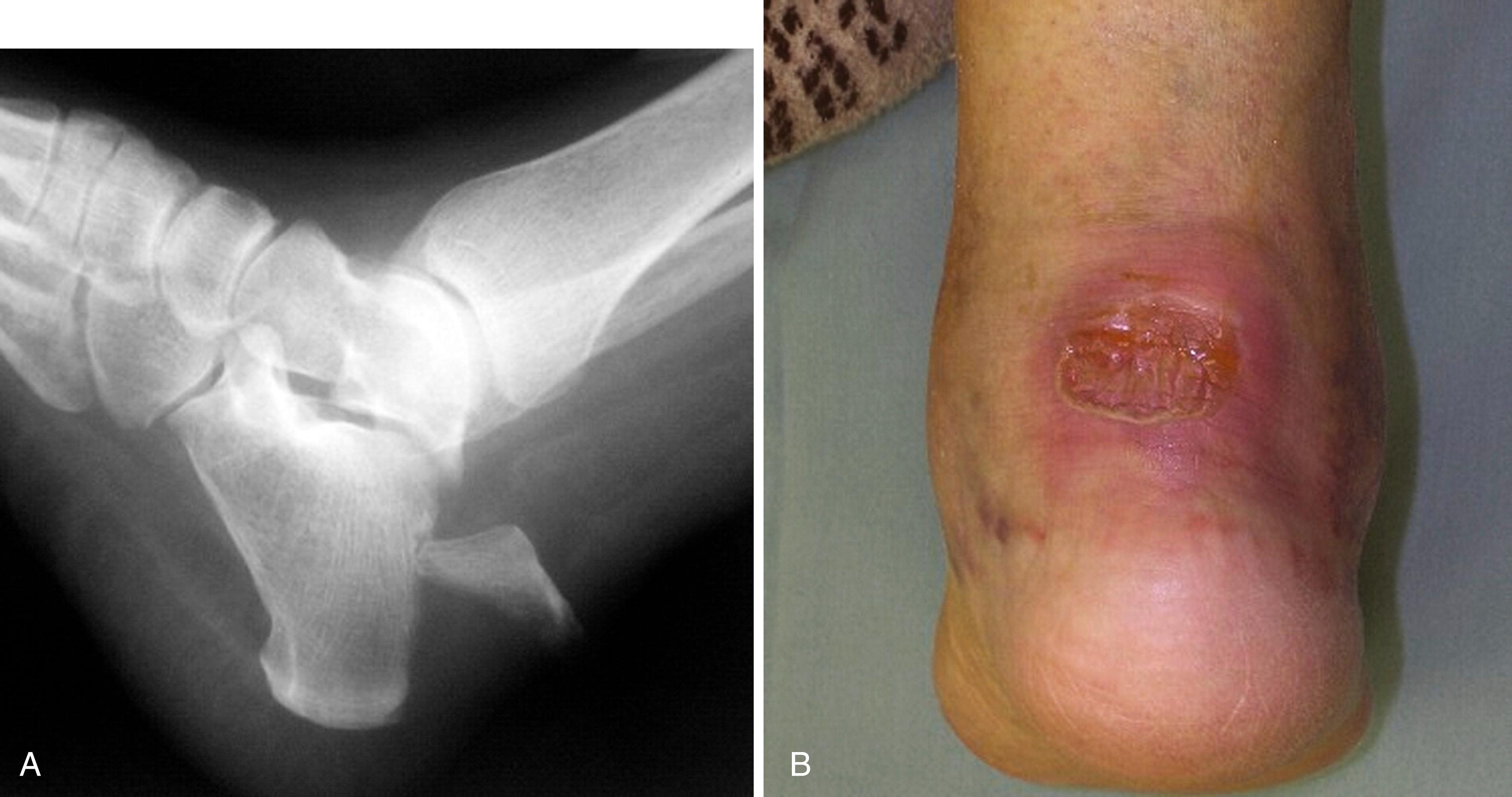 FIGURE 89.31, A, Calcaneal avulsion with large fragment. B, Open wound on posterior heel that developed when fracture was not treated expediently.
