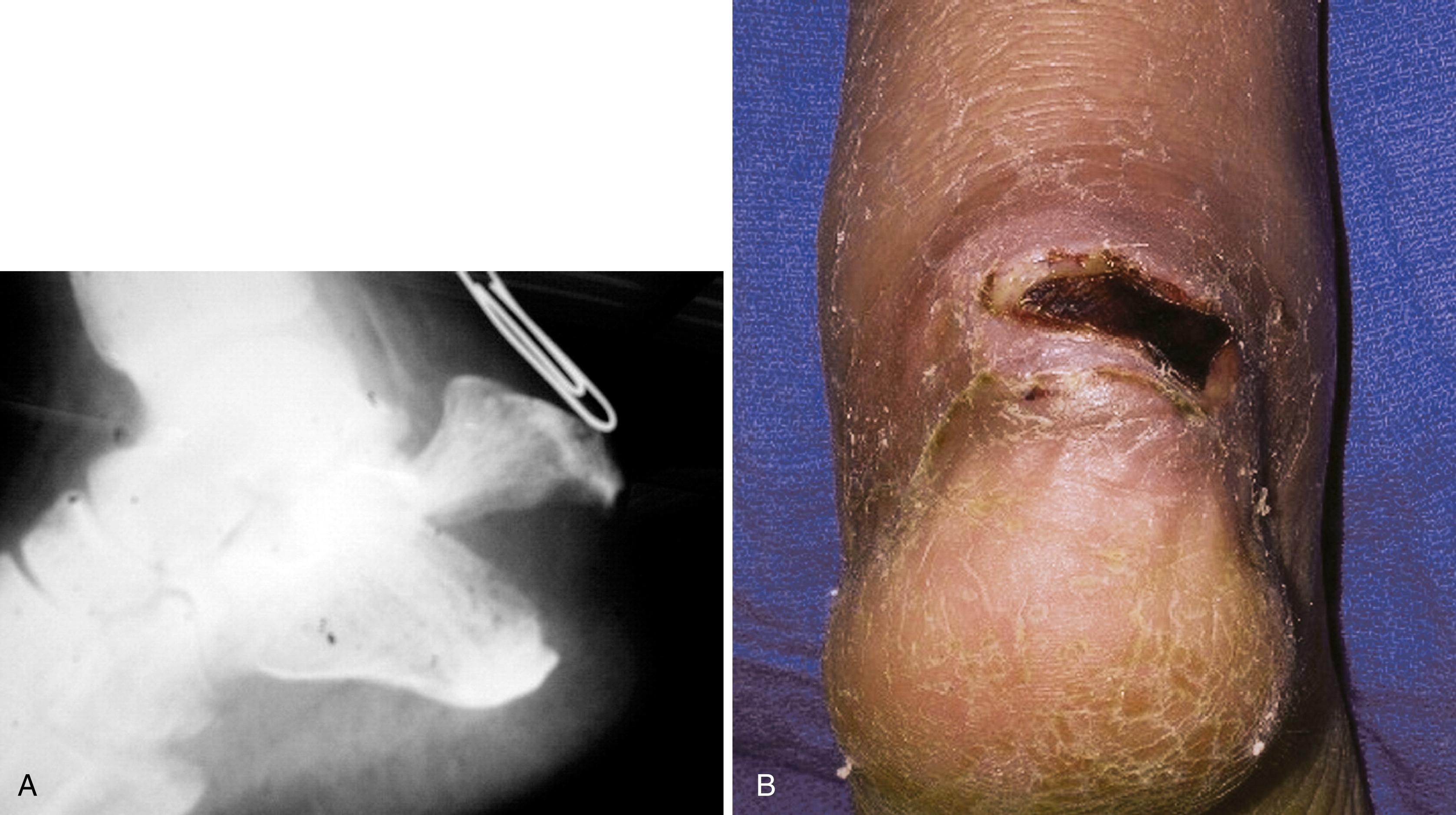 FIGURE 89.32, A, Displaced beak fracture. B, Skin necrosis 1 month after initial injury.