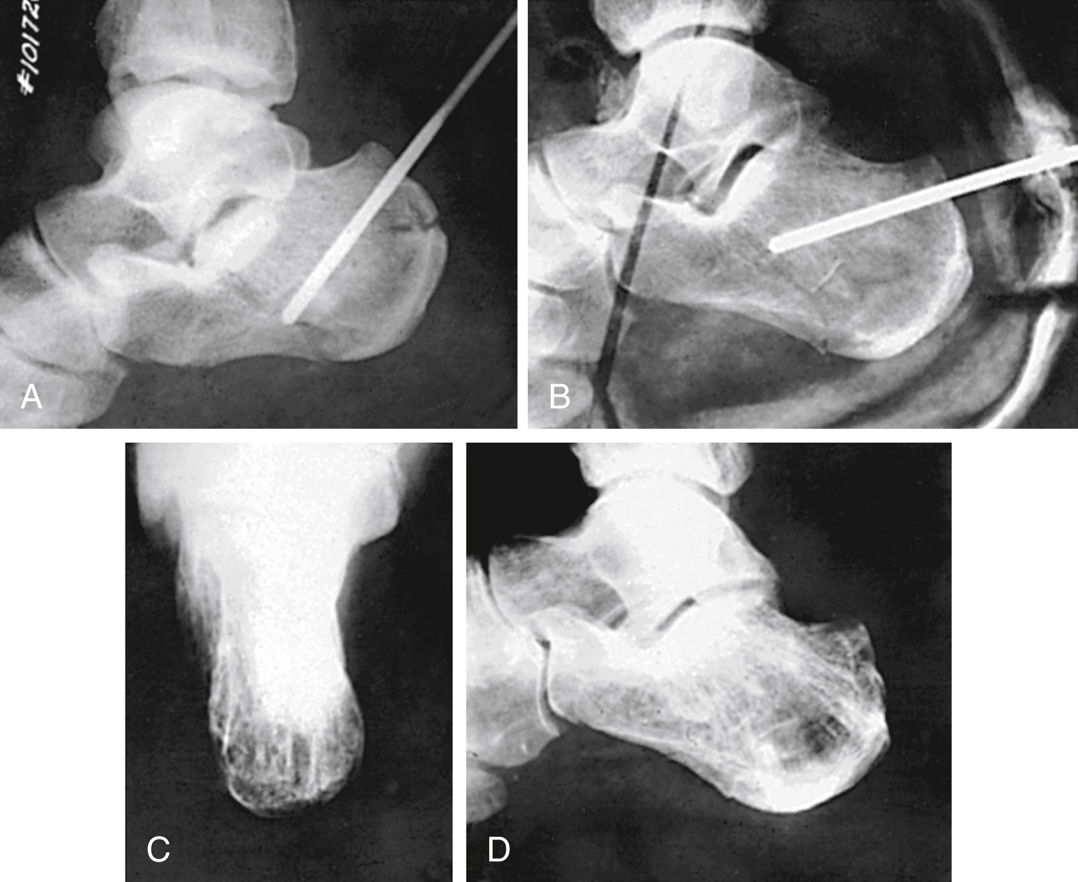 FIGURE 89.16, Essex-Lopresti reduction of fracture of calcaneus by manipulation and pin fixation. A, Correct position of pin. B, Postoperative radiograph through cast. C and D, Result after 1 year. Patient returned to work as deckhand on barge. SEE TECHNIQUE 89.4.