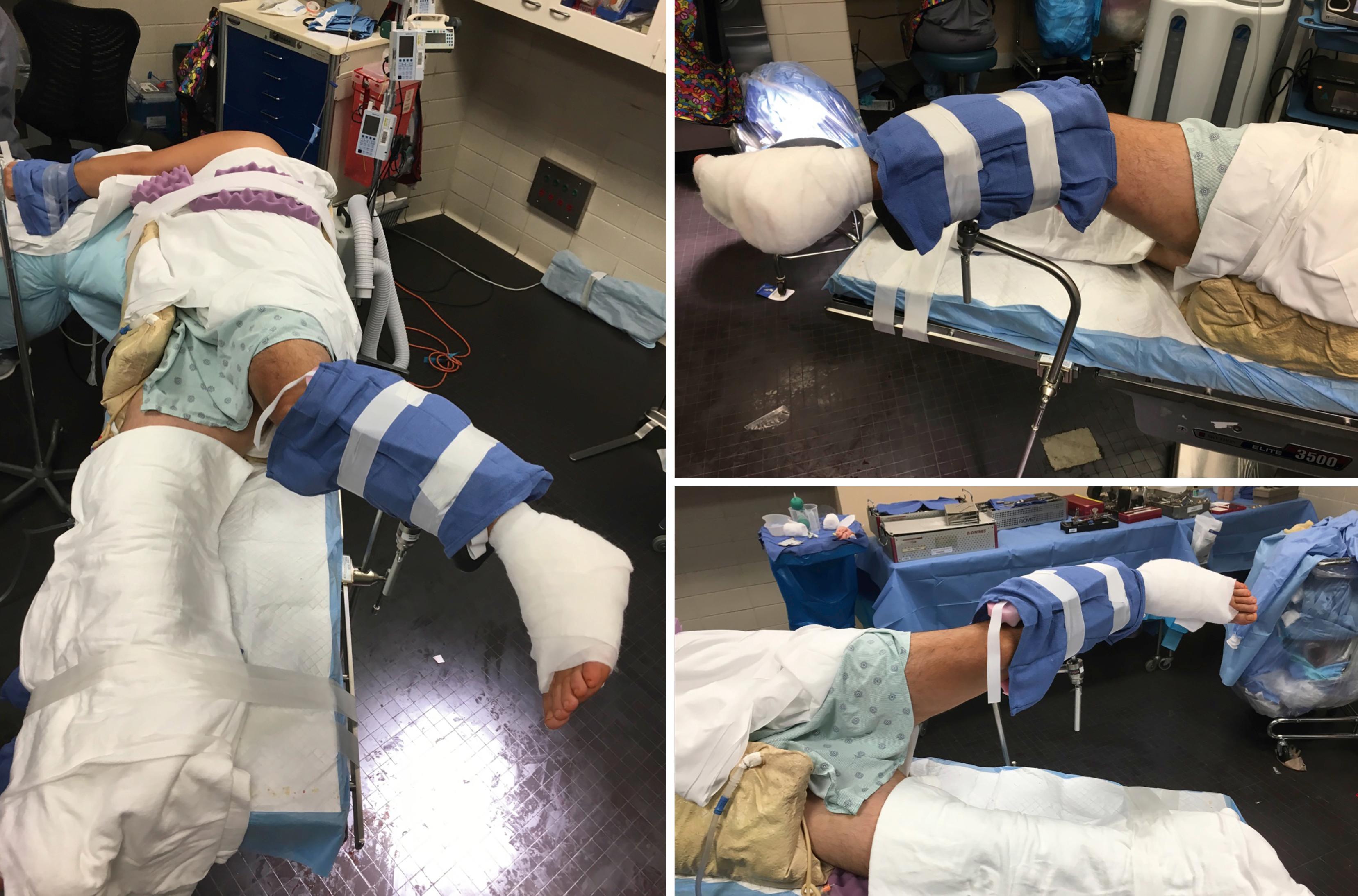 FIGURE 89.17, Percutaneous reduction and fixation of calcaneal fracture. Keeping the leg holder as proximal as possible allows access to ankle. SEE TECHNIQUE 8.5.