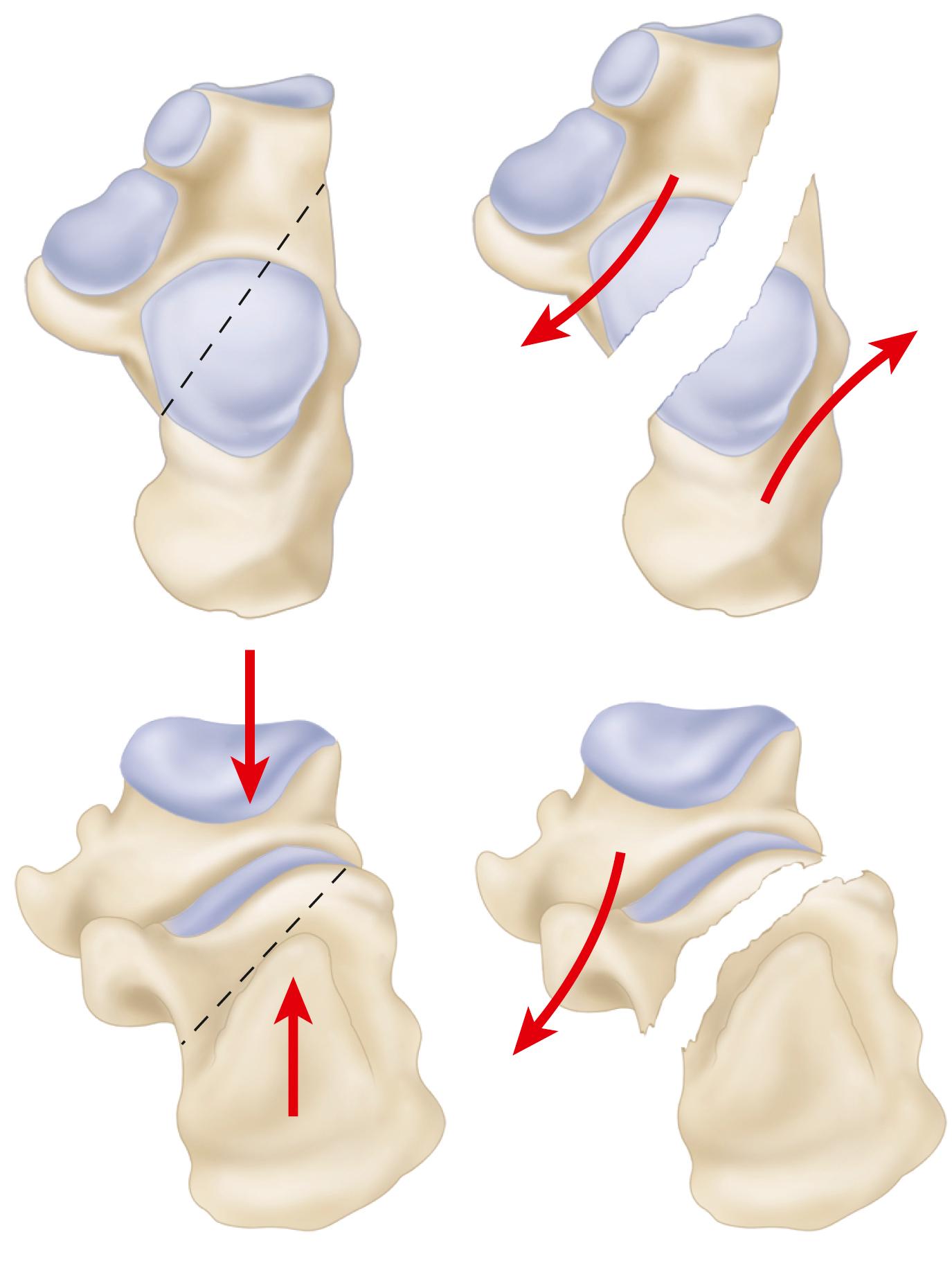 FIGURE 89.2, Primary fracture line occurs as result of shear force.