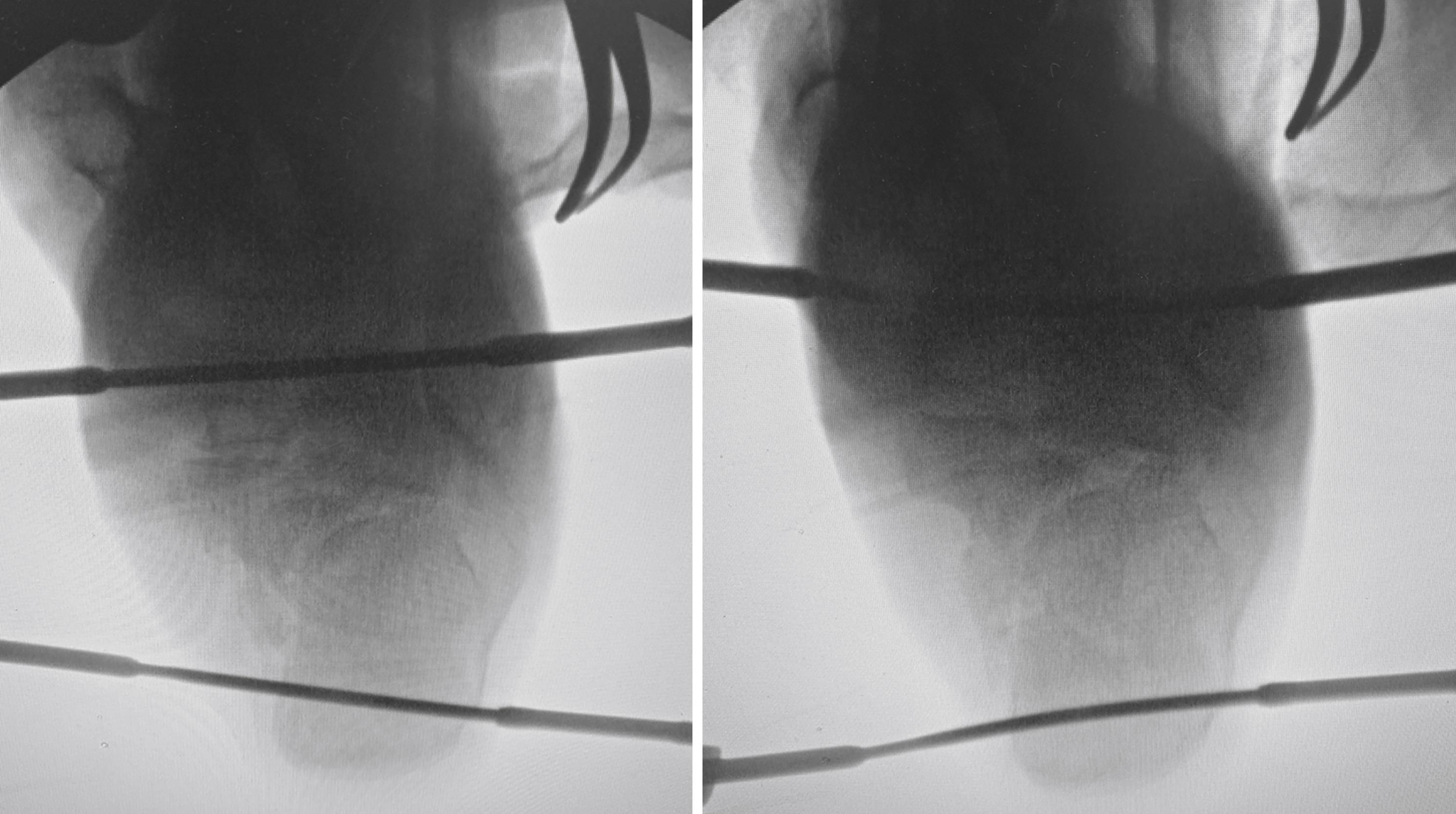 FIGURE 89.20, Continued dual distraction restores length and height of the calcaneus. SEE TECHNIQUE 89.5.