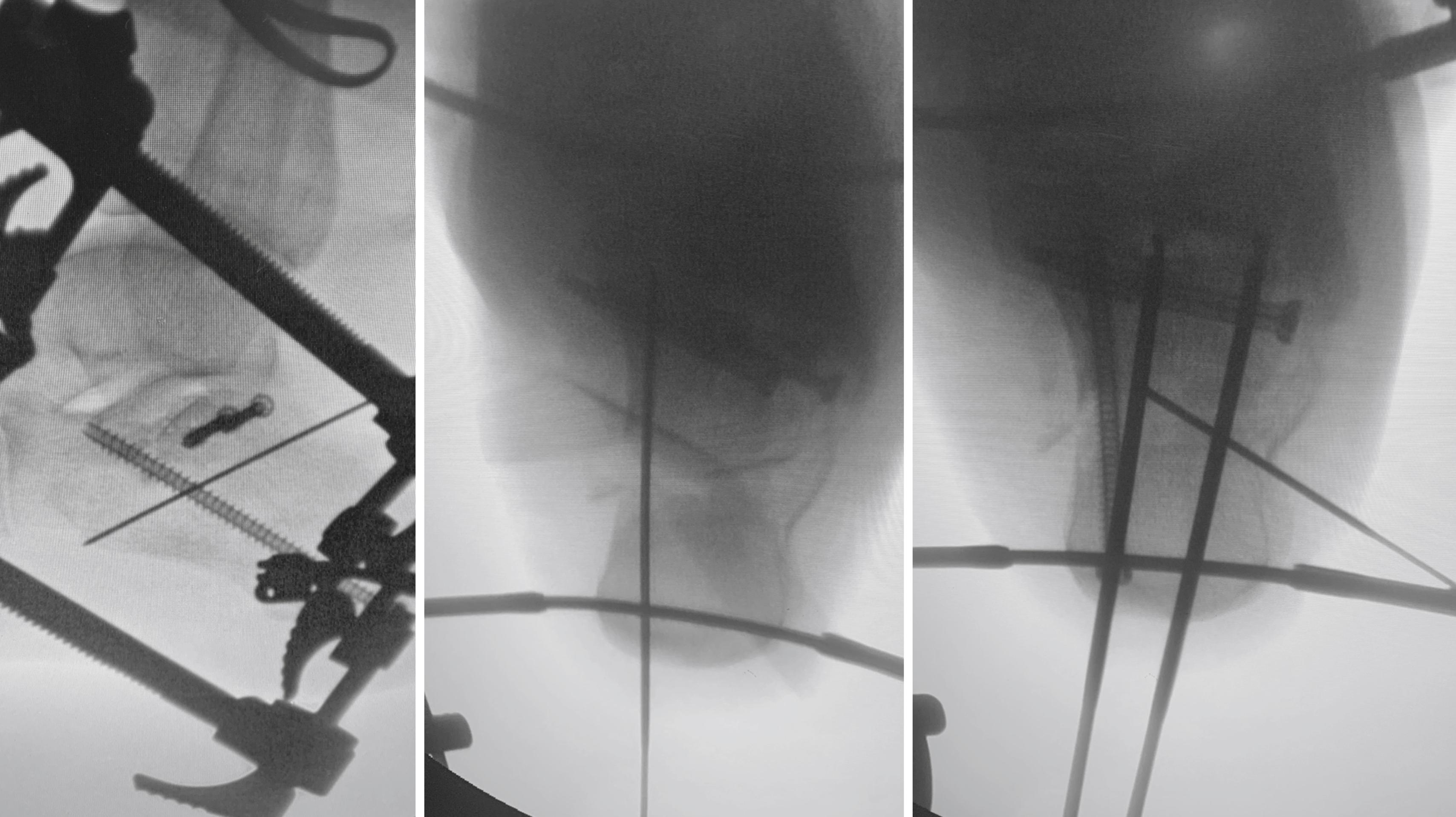 FIGURE 89.22, After elevation of posterior facet fragments into appropriate position, cannulated or solid screws are placed from lateral to medial to anchor posterior facet to sustentaculum tali. SEE TECHNIQUE 89.5 .