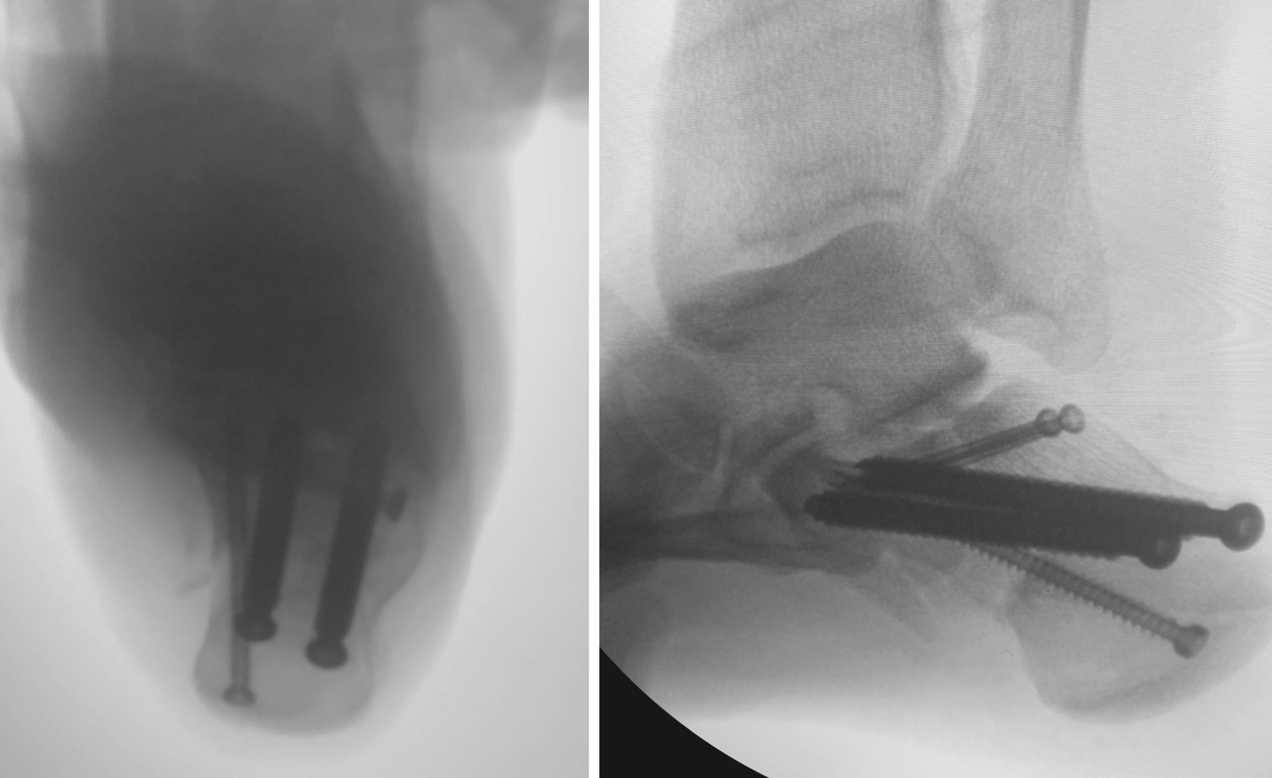 FIGURE 89.23, Three larger cannulated screws are inserted from tuberosity into sustentaculum, under posterior facet, and into anterior process SEE TECHNIQUE 89.5.