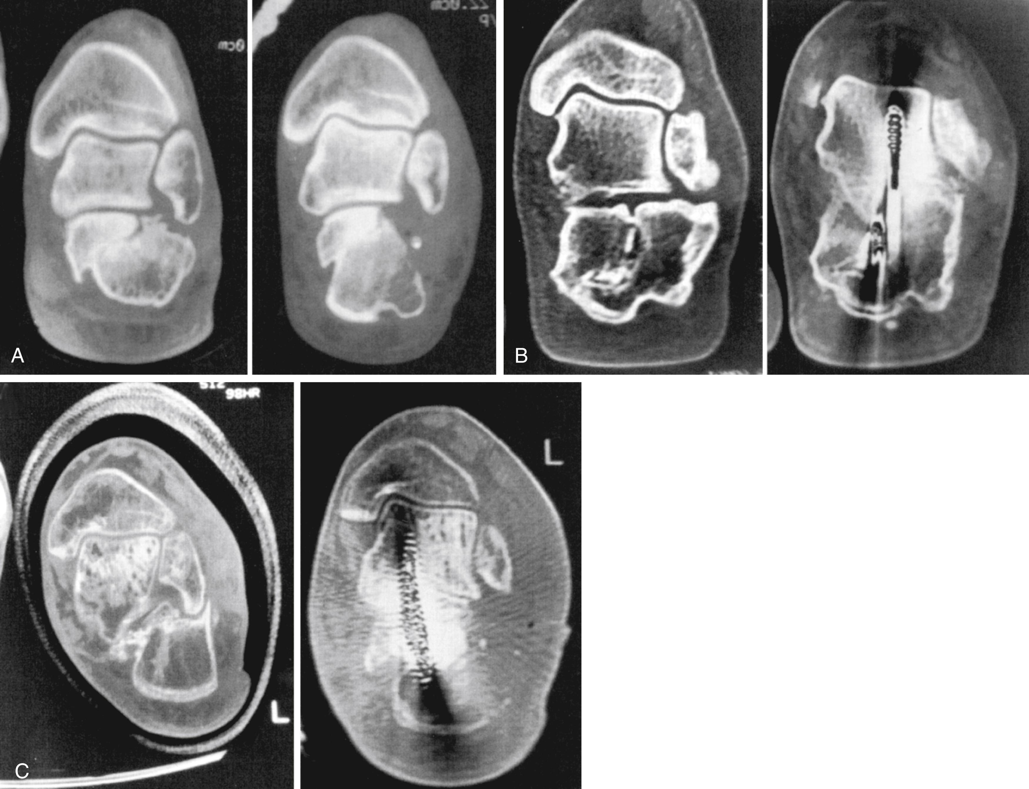 FIGURE 89.24, Classification of calcaneal malunions (Stephens and Saunders). A, Type I, lateral wall bulge and far lateral subtalar arthrosis. B, Type II, significant subtalar arthrosis. C, Type III, varus angulation and subtalar arthrosis.