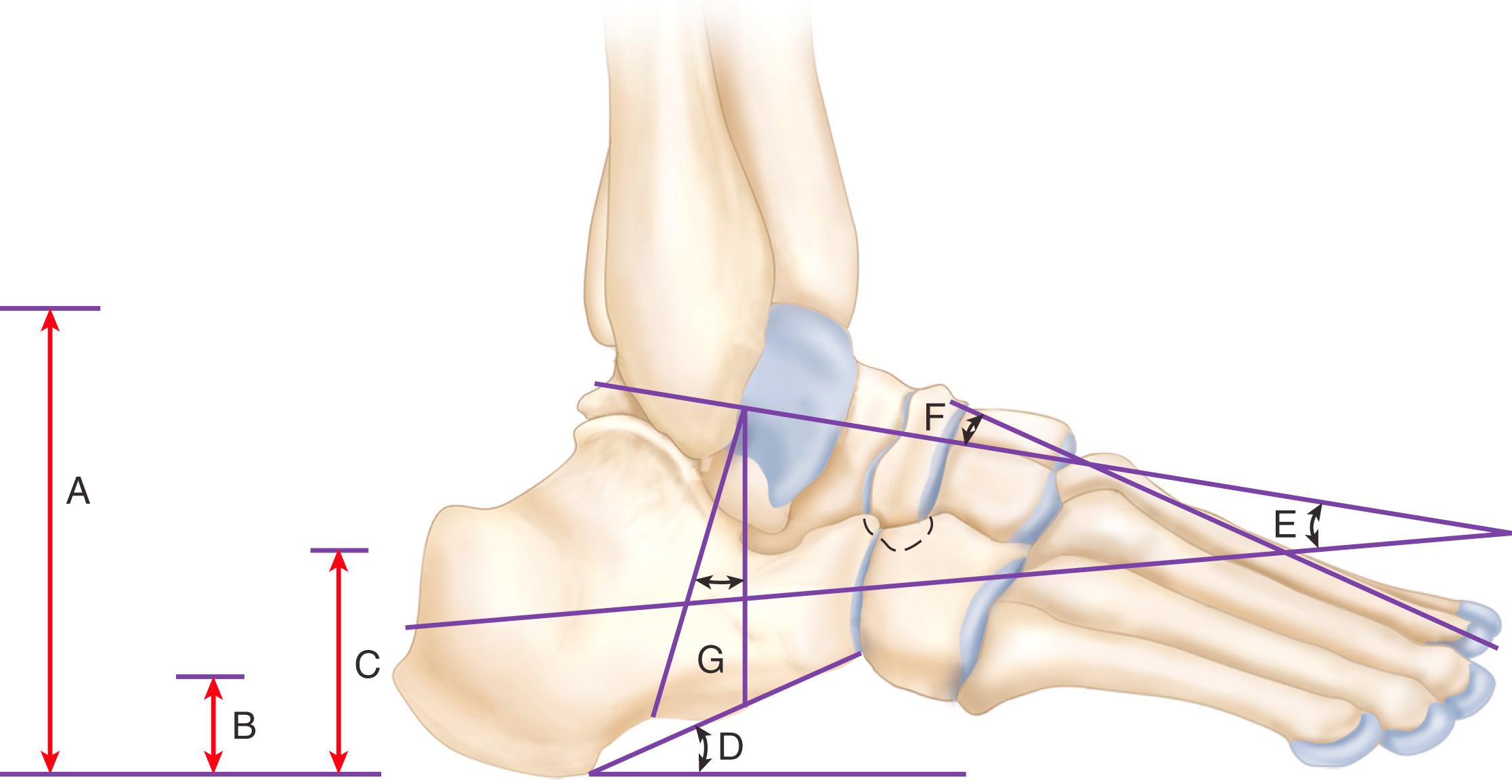 FIGURE 89.27, Radiographic measurements. A, Talocalcaneal height. B, Cuboid-to-floor distance. C, Navicular-to-floor distance . D, Calcaneal pitch angle. E, Talocalcaneal angle. F, First talometatarsal angle. G, Talar declination angle.