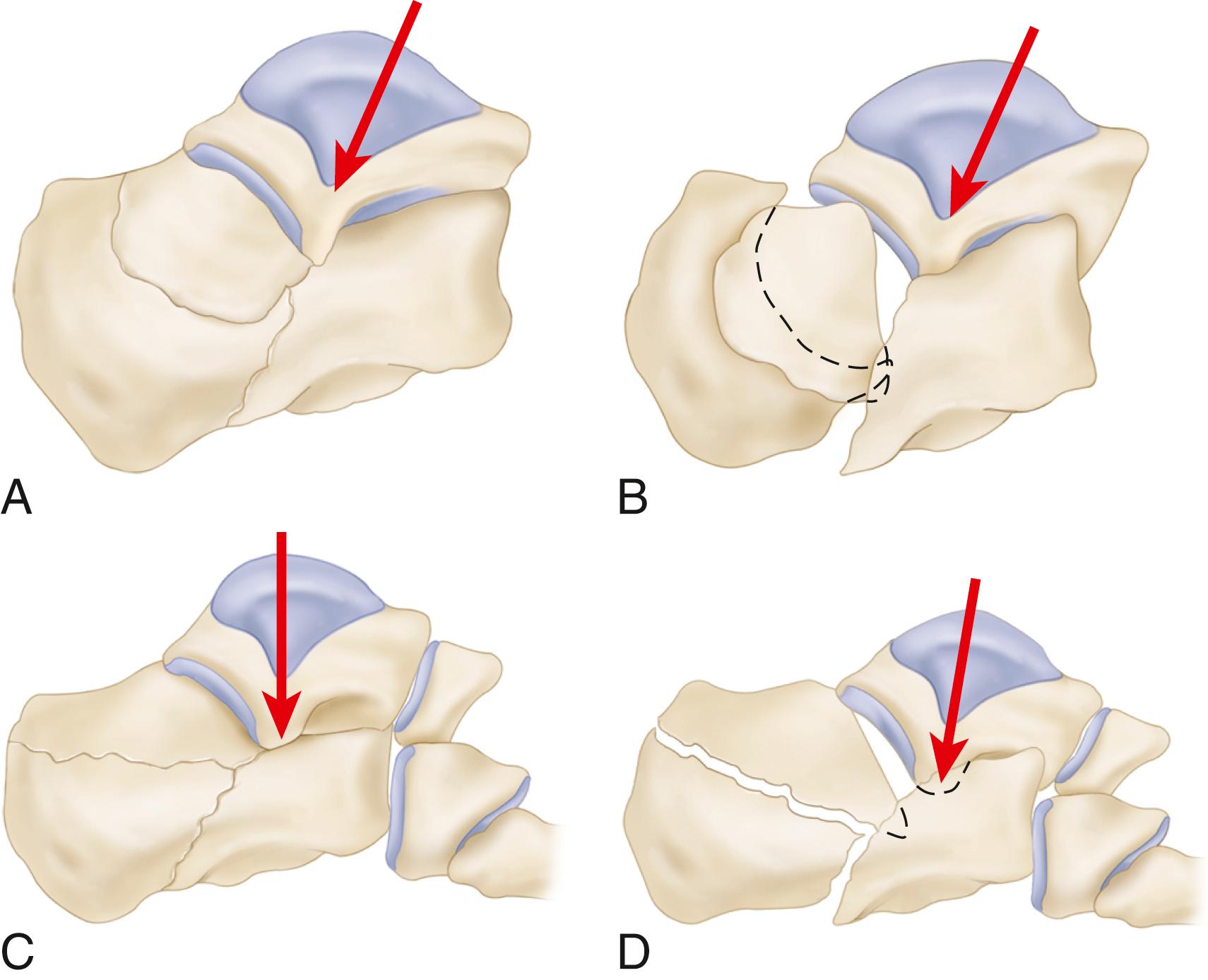 FIGURE 89.3, A to D, Essex-Lopresti classification of fractures of calcaneus (see text).