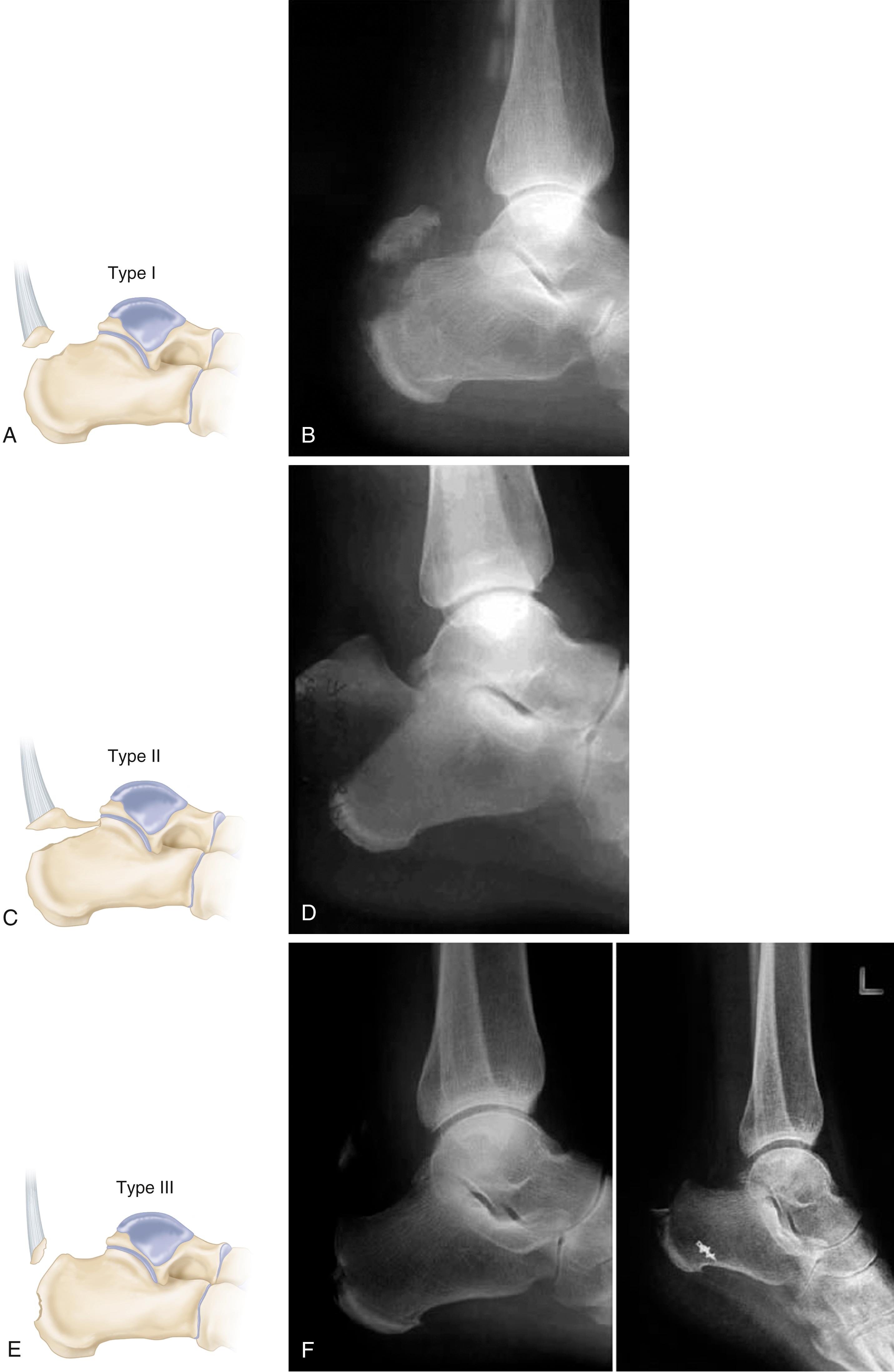 FIGURE 89.30, Classification of calcaneal tuberosity fractures. A and B, Type I, sleeve fracture. C and D, Type II, beak fracture. E and F, Type III, infrabursal fracture.