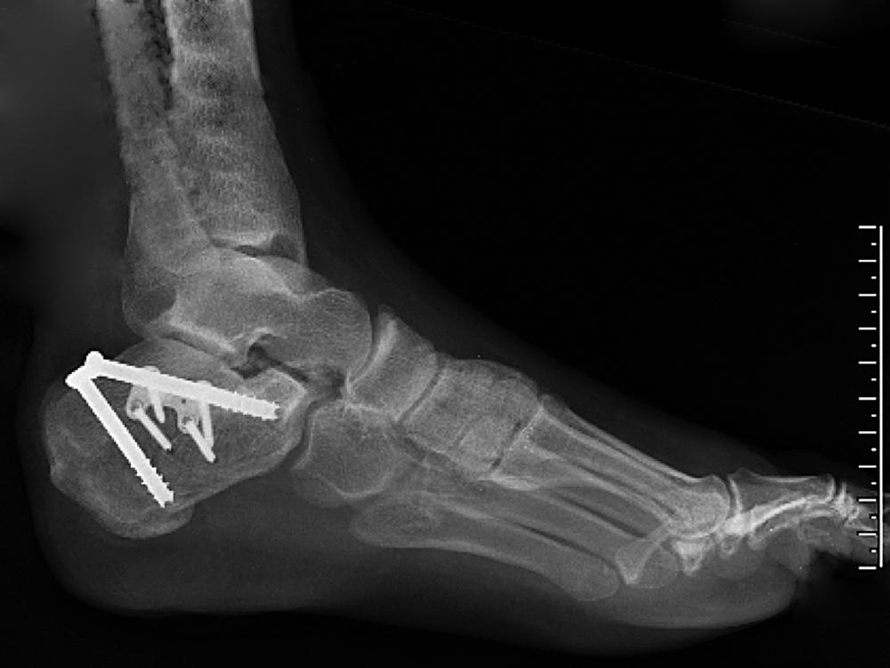 FIGURE 89.33, Plate and screw fixation of type II calcaneal avulsion fracture.