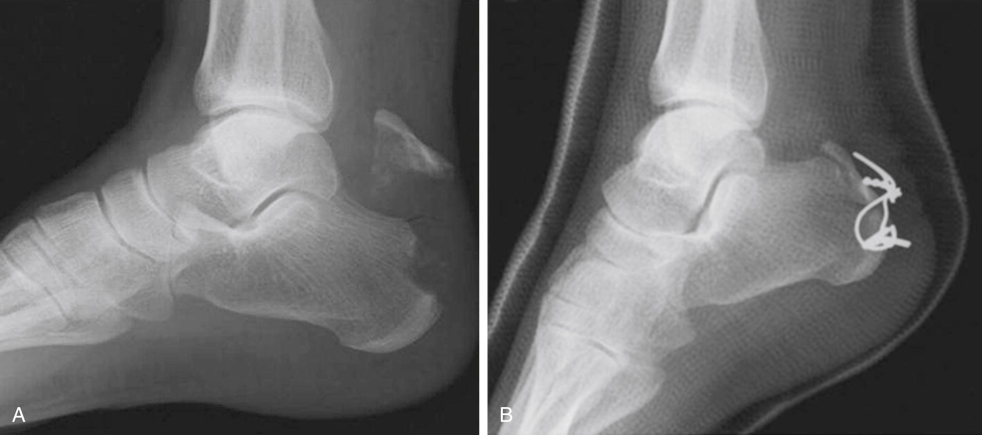 FIGURE 89.34, A, Proximally displaced avulsion fracture of calcaneus. B, Lateral tension band fixation.