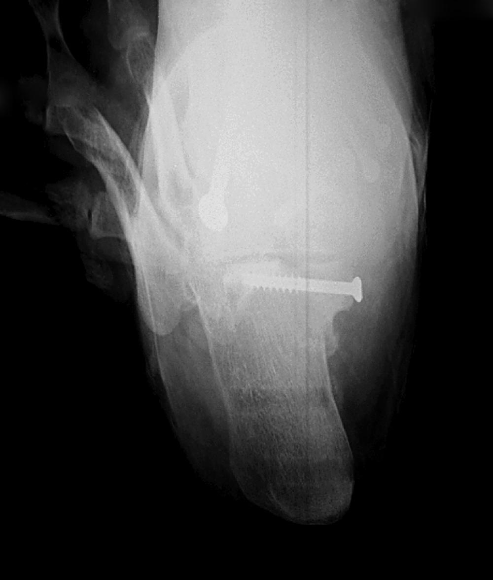 FIGURE 89.35, Internal fixation of sustentaculum fracture with single screw.