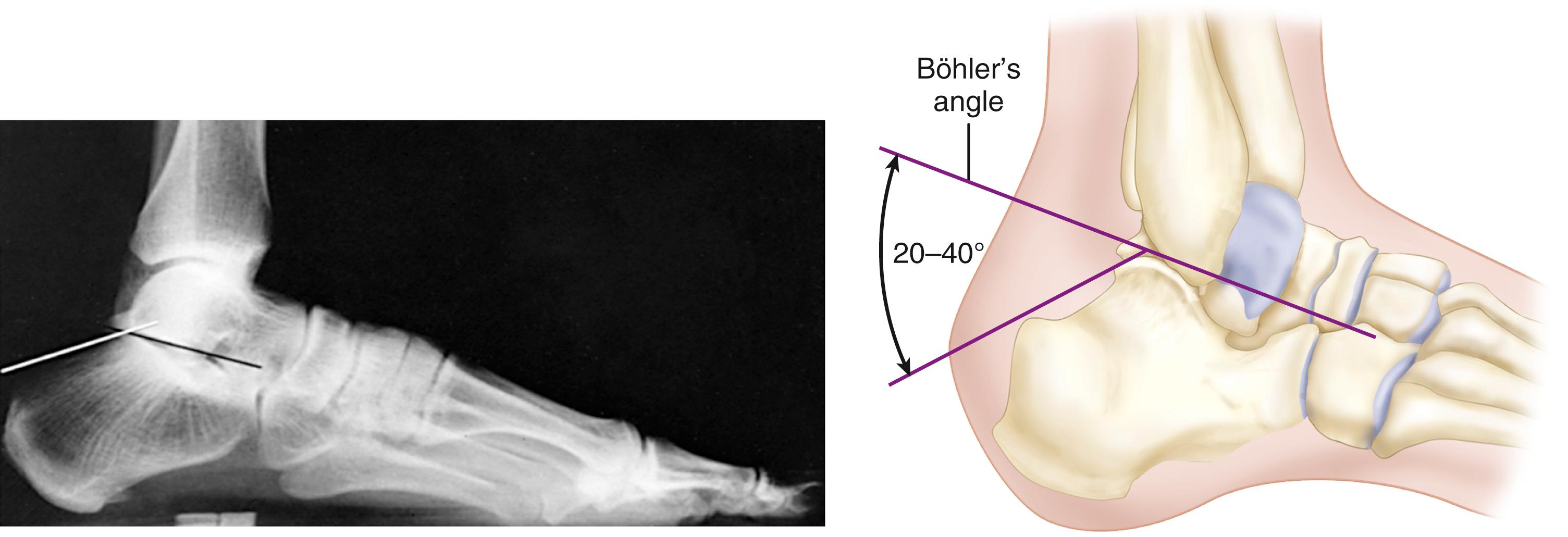 FIGURE 89.4, Böhler’s angle (see text).